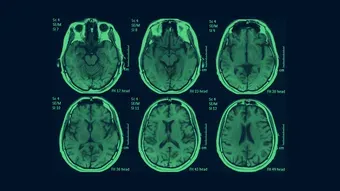 Syndrome du bébé secoué, un scandale français