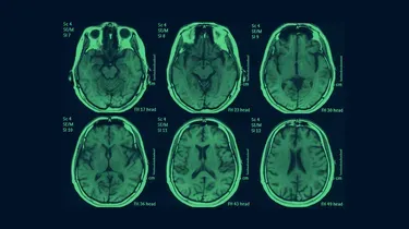 Syndrome du bébé secoué, un scandale français